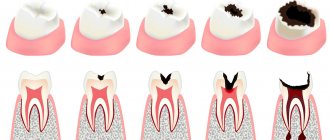 Stages of caries