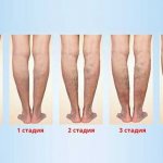 Stages of development of ulcers with varicose veins