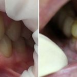 Tooth wear due to malocclusion