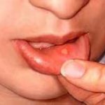 stomatitis in children