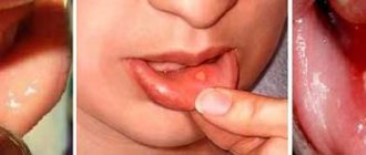 stomatitis in children