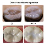 Стоматологические силаннты