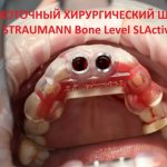 This is what a high-precision surgical template looks like for the Straumann Bone Level SLActive implantation system, as part of a complete protocol for implantation of the upper anterior incisors