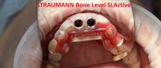 This is what a high-precision surgical template looks like for the Straumann Bone Level SLActive implantation system, as part of a complete protocol for implantation of the upper anterior incisors