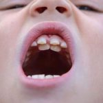 Children have shark teeth, what is dangerous or not to do?