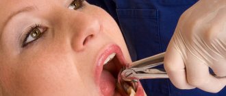 Molar tooth extraction