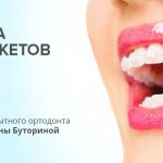 Установка белых брекетов