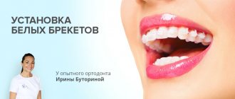 Установка белых брекетов