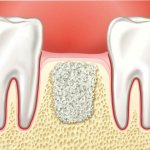 Installation of a dental implant