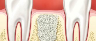 Installation of a dental implant