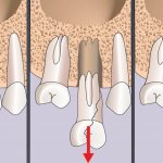 Implant installation