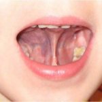 Tongue frenulum