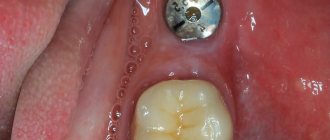 a gum former is screwed into the implant