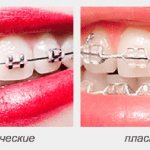 Types of braces