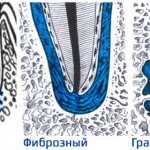 Types of periodontitis, acute and chronic forms