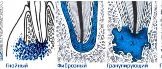 Types of periodontitis, acute and chronic forms