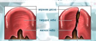 types of cleft palate