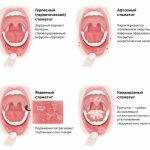 Types of stomatitis