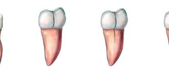 types of cracks in teeth