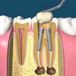 Types of dental pins