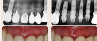 inflammation of the salivary gland under the tongue