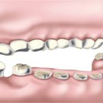 Restoring bite height