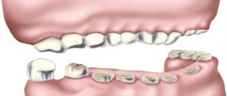 Restoring bite height