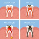 Возникновение периостита и его последствия в картинках