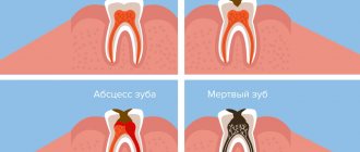 Возникновение периостита и его последствия в картинках