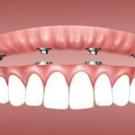 implantation of dental implants