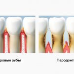 Здоровые зубы и пародонтит в картинках