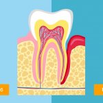 Здоровый зуб и пародонтит в картинках