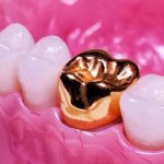 Gold crown on a tooth