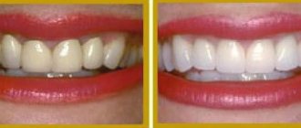 Rembrandt whitening toothpaste