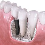 Dental implant