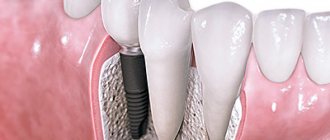 Dental implant