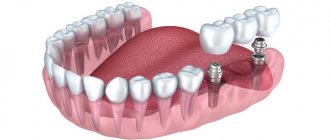Зубной мост на имплантах