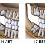 Wisdom teeth form after the molars appear.